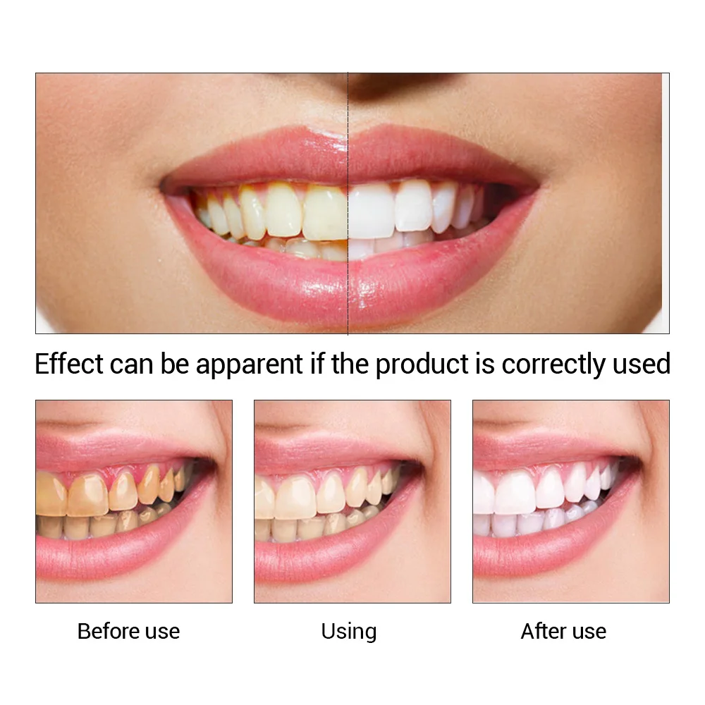 FTEENPLY Zahnaufhellung Essenz – Teeth Whitening Diy Bewertung und Preis
