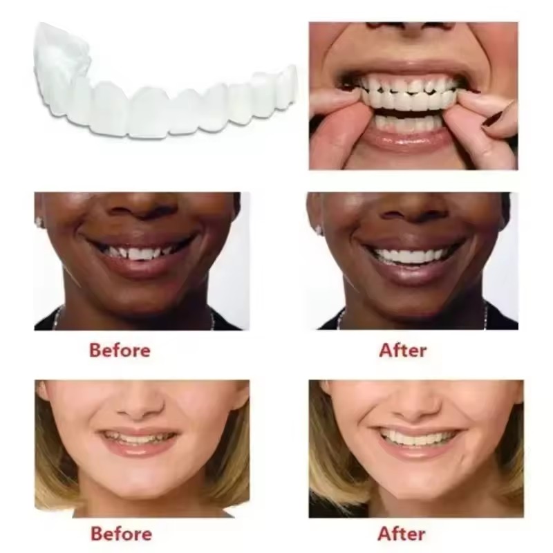 Zahn-Veneers Zahnaufhellung Za – Teeth Whitening Veneers Bewertung und Preis