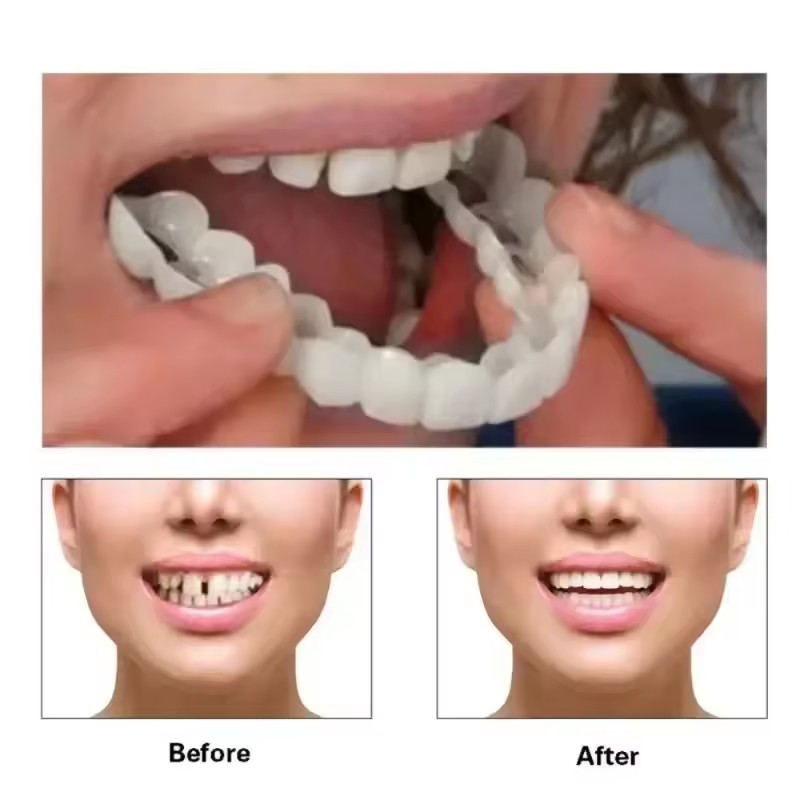 Zahn-Veneers Zahnaufhellung Za – Teeth Whitening Veneers Bewertung und Preis