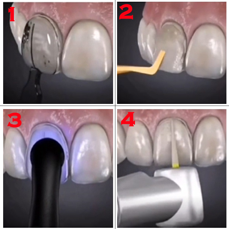 Zahnform für Komposit-Harz-Ven – Teeth Whitening Veneers Bewertung und Preis