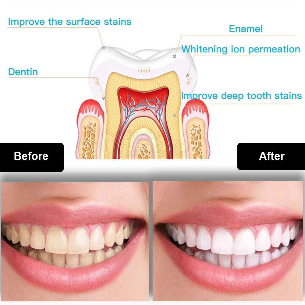 Dental Zahnaufhellung Kit Mini – Teeth Whitening Pens Bewertung und Preis